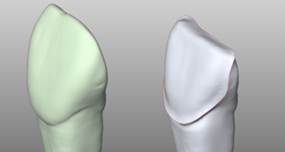 Klassische Präparation von Veneers – Ansicht 3 Klassische Präparation von Veneers - Ansicht 3