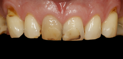 Veneers Ausgangsbefund Veneers Ausgangsbefund
