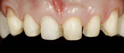 Veneers Präparation Veneers Präparation
