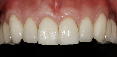 Veneers Behandlungsergebnis Veneers Behandlungsergebnis