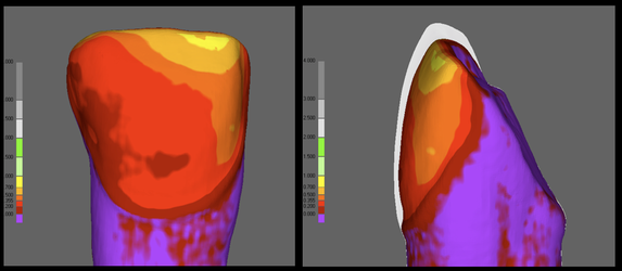 Minimalinvasive Präparation von Veneers
