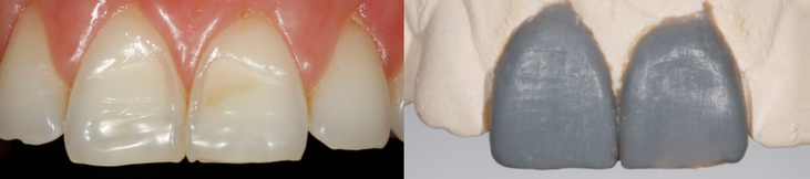 Veneers Ausgangsbefund / Wax-Up