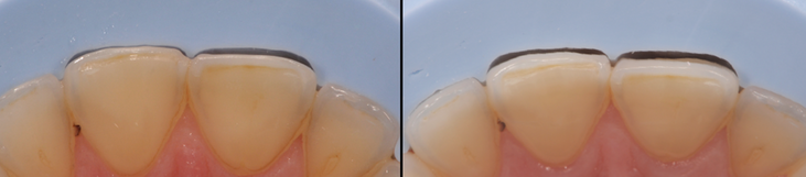 Veneers Präparationsschlüssel