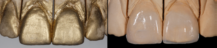 Keramik Veneers auf dem Gipsmodell