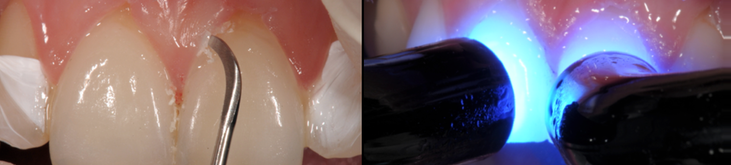 Entfernung der Überschüsse des Befestigungsmaterials der Veneers / Lichhärtung
