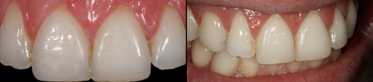 Behandlungsergebnis der Veneers