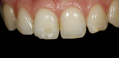 Non-Prep Veneers vorher
