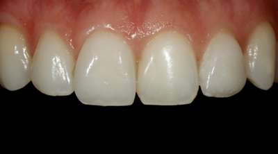 Non-Prep Veneers nachher