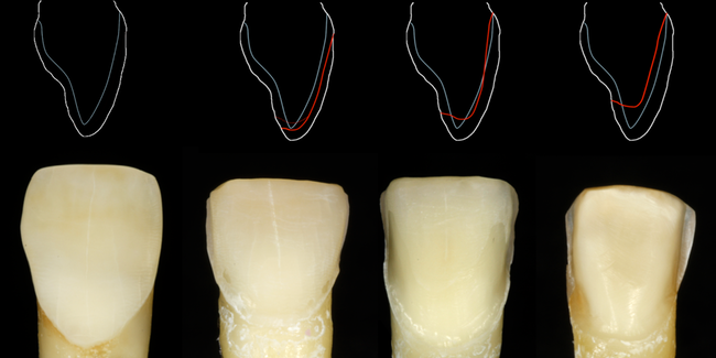 Präparation von Veneers Präparation von Veneers
