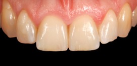 Handgefertigte Frontzahn Veneers
