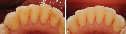 Zähne Bleichen, Zahnaufhellung, Bleaching Vorher/Nachher