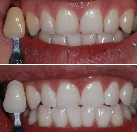 In Office Bleaching, Zähne Bleichen, Zahnaufhellung