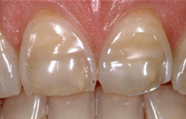 Veneer Indikationen 1