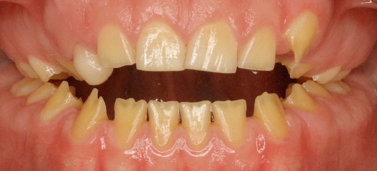 Amelogenesis Imperfecta Beispiel