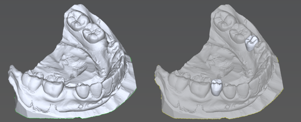 Implantat Virtuelle Planung