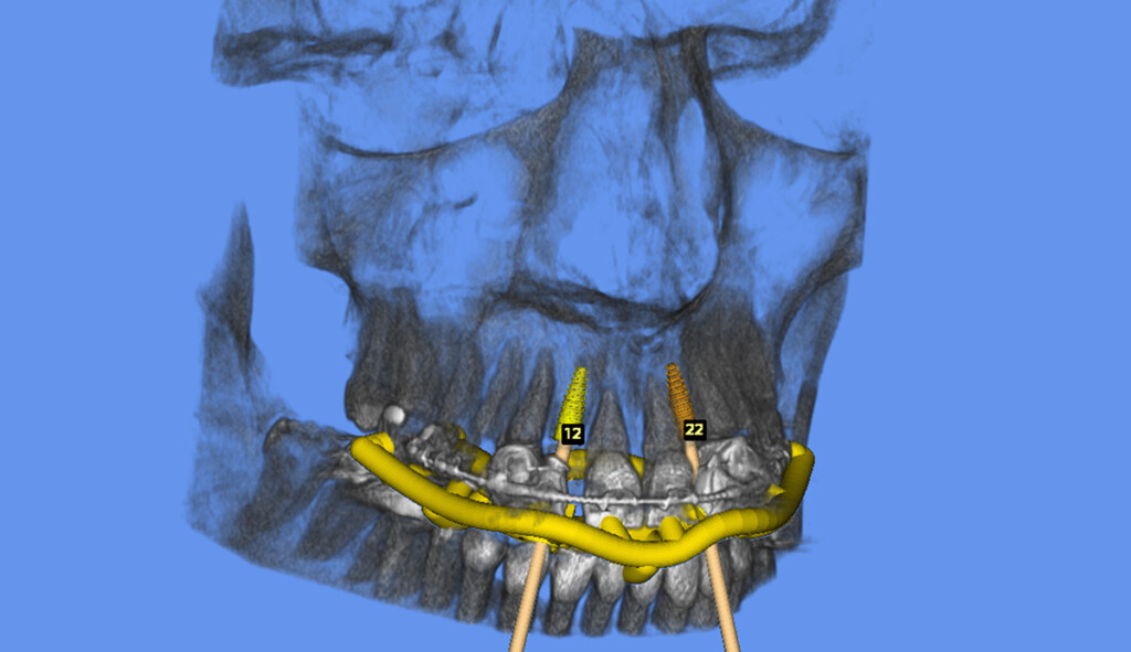 Implantat Knochen und Bohrschablone