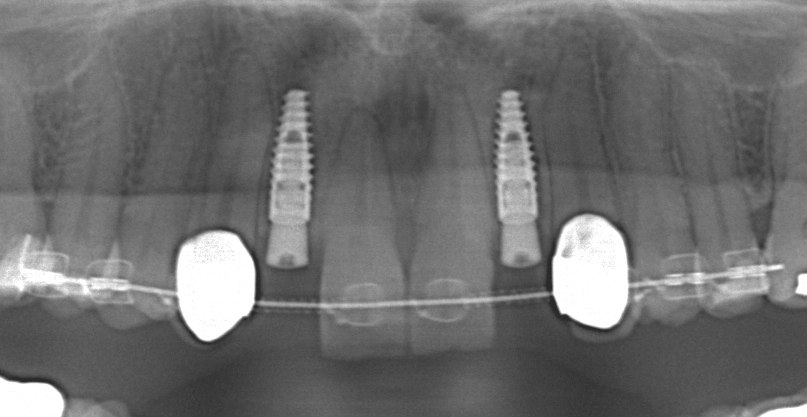 Implantate der oberen Schneidezähne