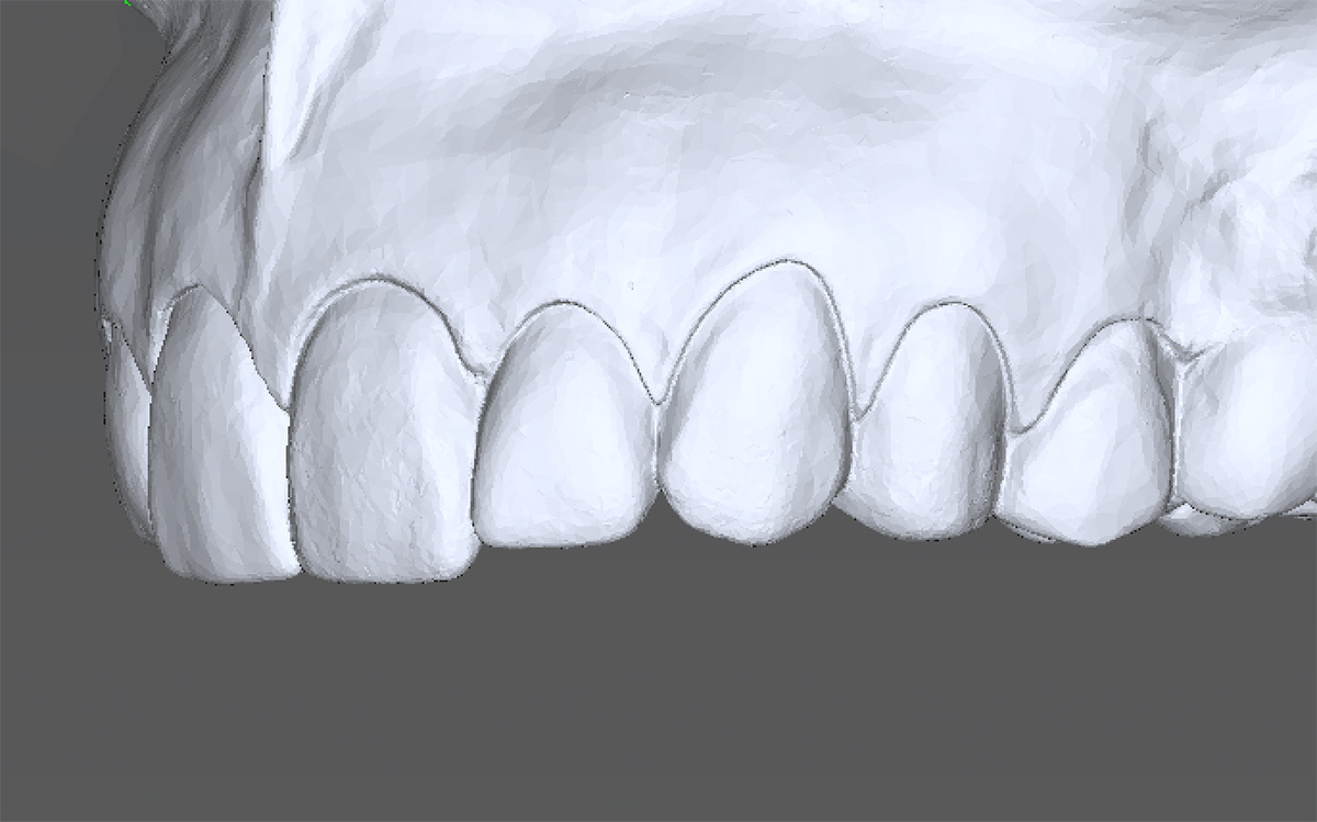 Gummy Smile 3D Scan und Wax-up Gummy Smile 3D Scan und Wax-up