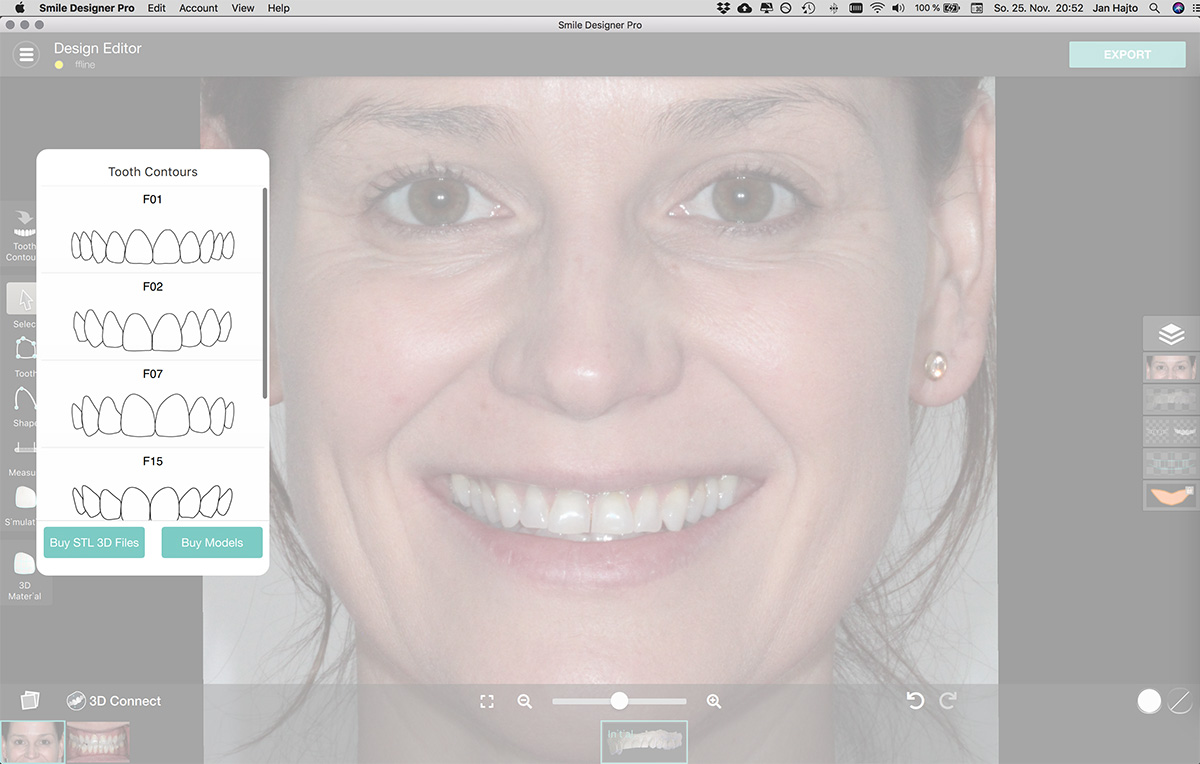 Smile Design Auswahl der Zahnform Smile Design Auswahl der Zahnform
