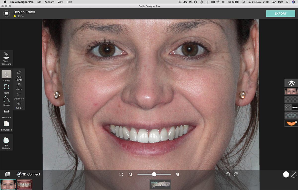 Smile Design Simulation Lächeln Smile Design Simulation Lächeln