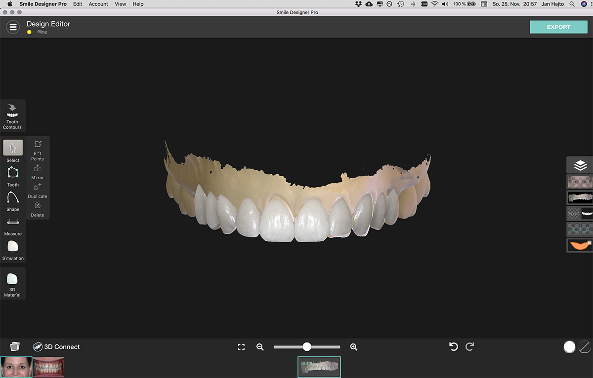 Smile Design 3D Scan Smile Design 3D Scan