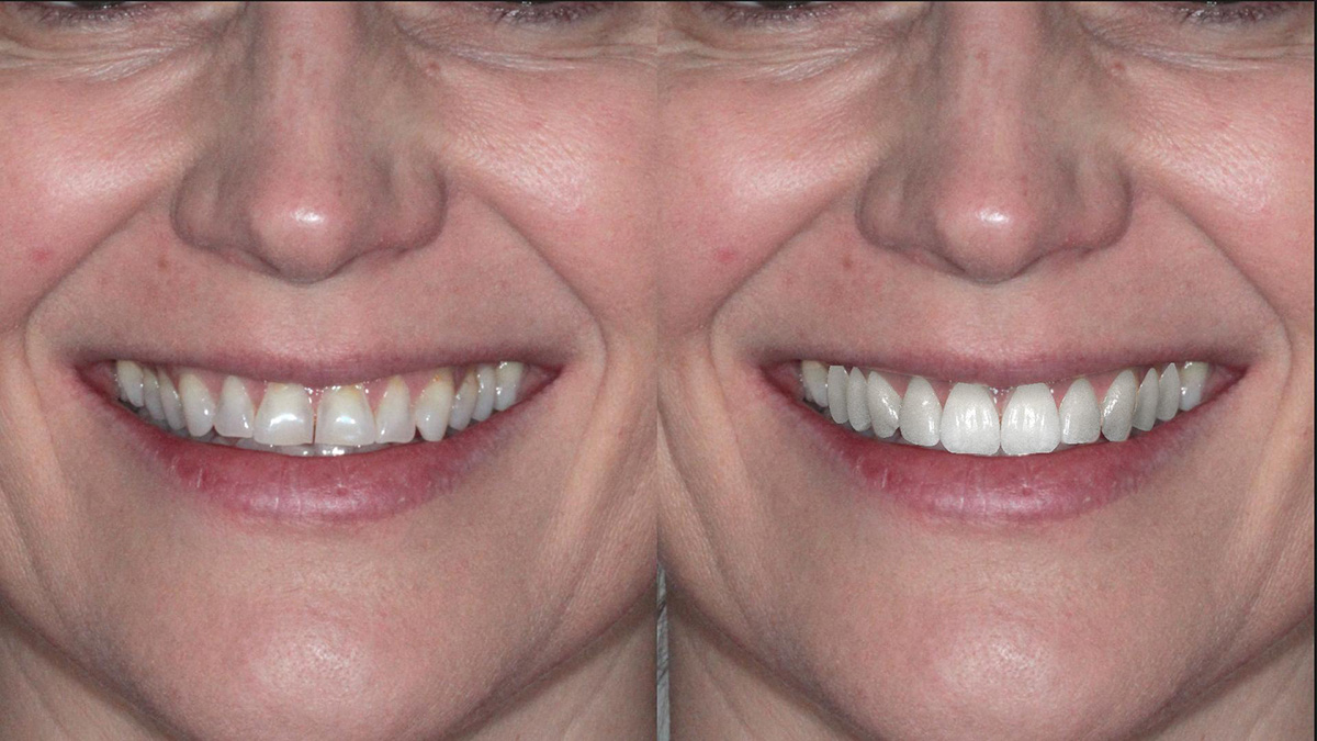 Smile Design Simulation Vergleich Vorher Nachher Smile Design Simulation Vergleich Vorher Nachher