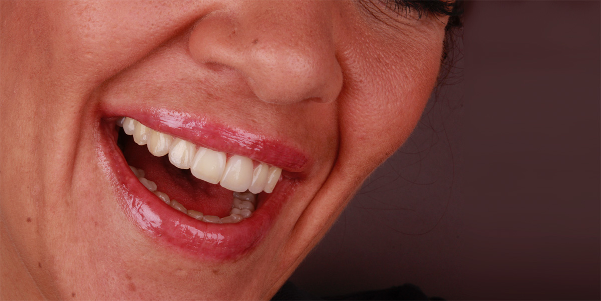 Smile Design Einprobe Smile Design Einprobe