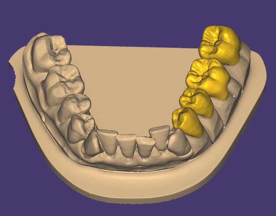 Zahnmodell in der Exocad Software