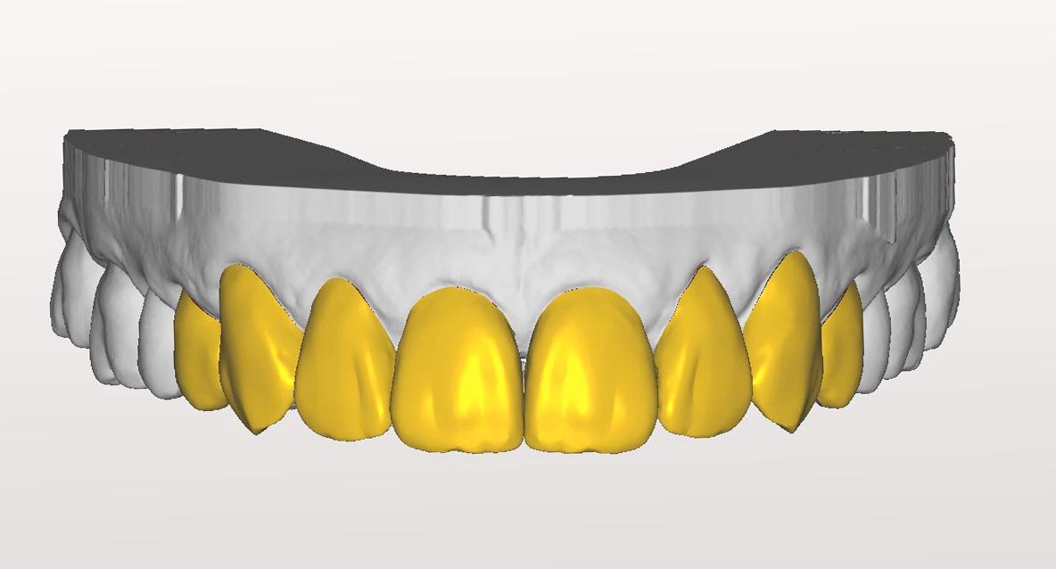Frontzahndesign mit der Form Anteriores F1
